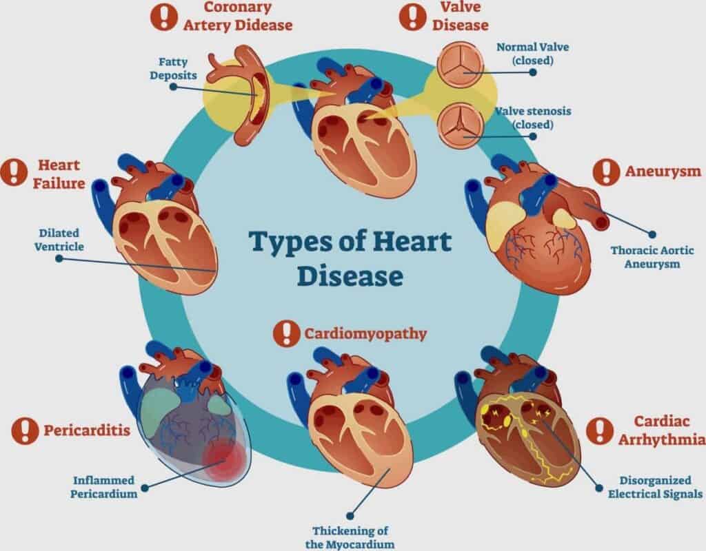 Types of Heart Disease Illustration