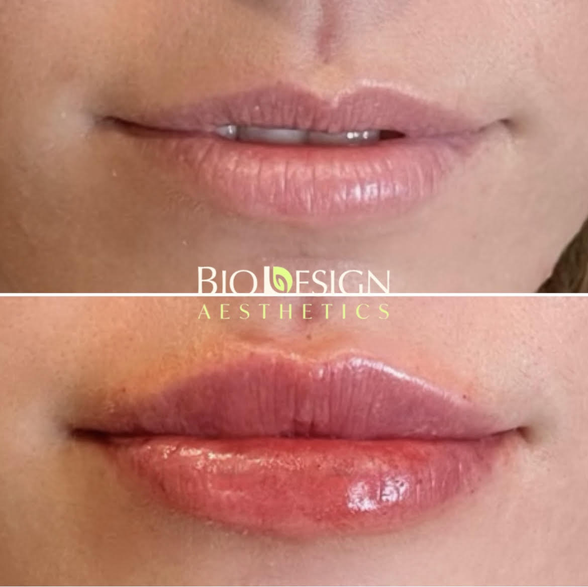 Lip Enhancement In Tampa, FL